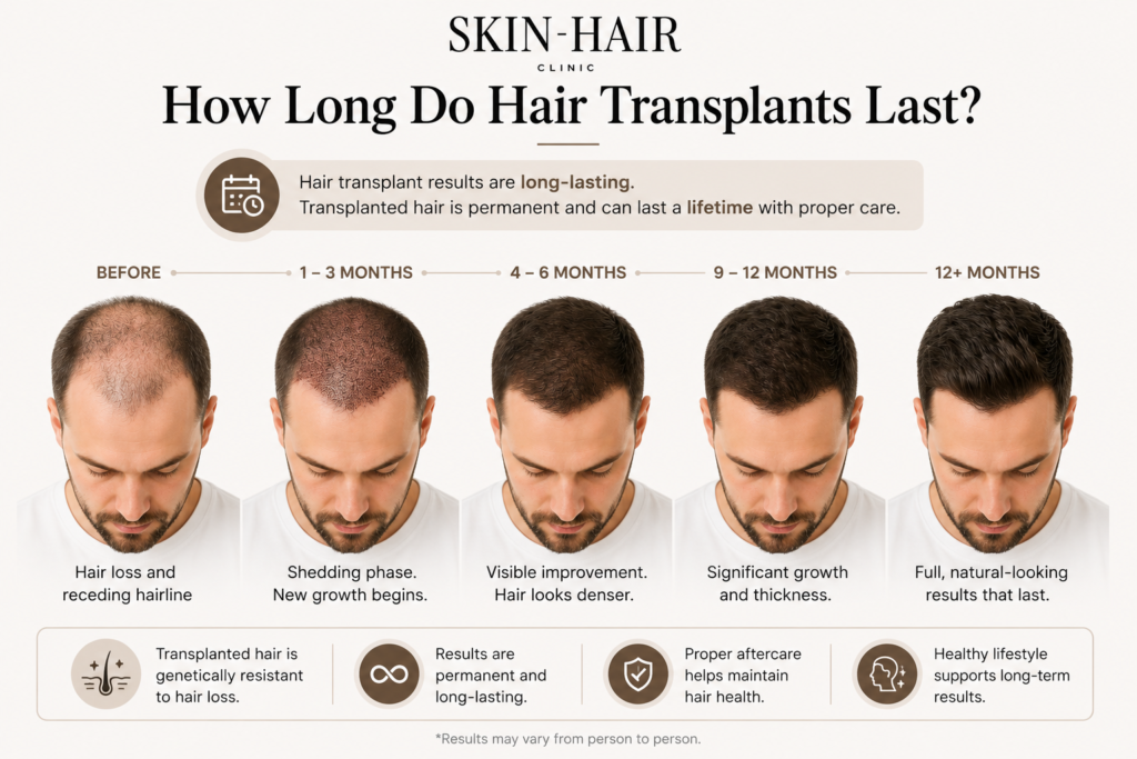 How long do hair transplants last?