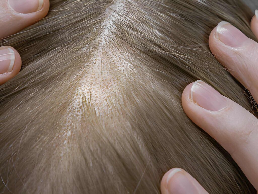 Everything about Hair Transplant for Women