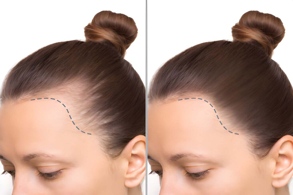 Hair Transplant For Women - Trasplante Capilar Para Mujeres