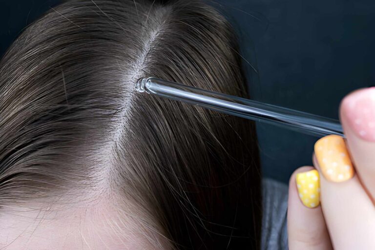 Finasteride para el cabello